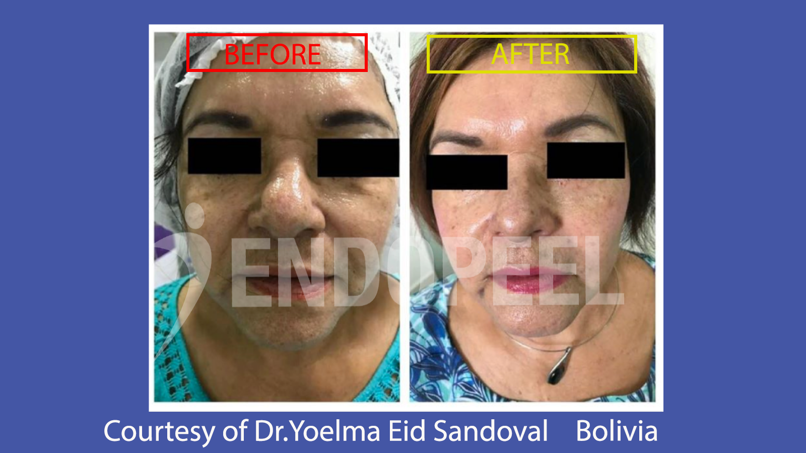 Eyebags Treatment and Endopeel