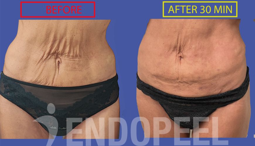 female abdominoplasty