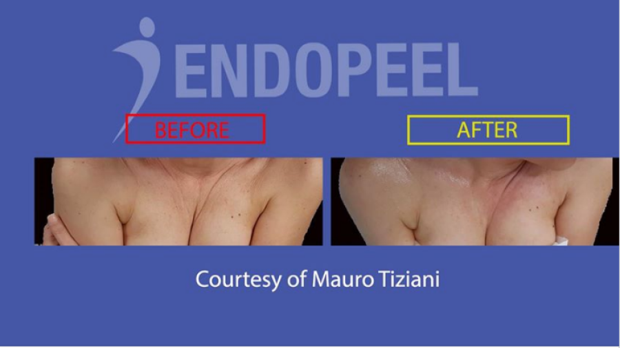 endopeel decollete