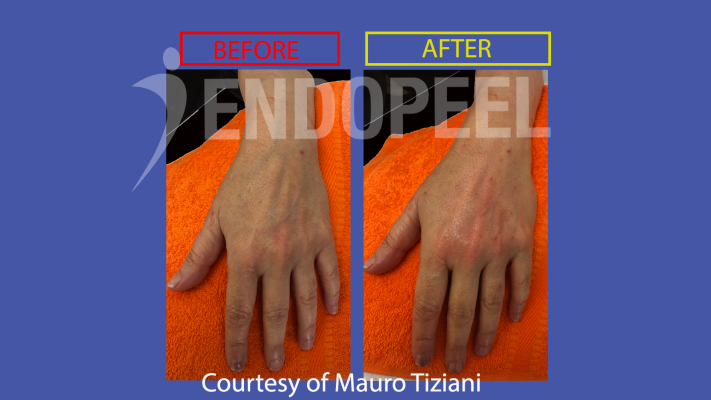 hands rejuvenation