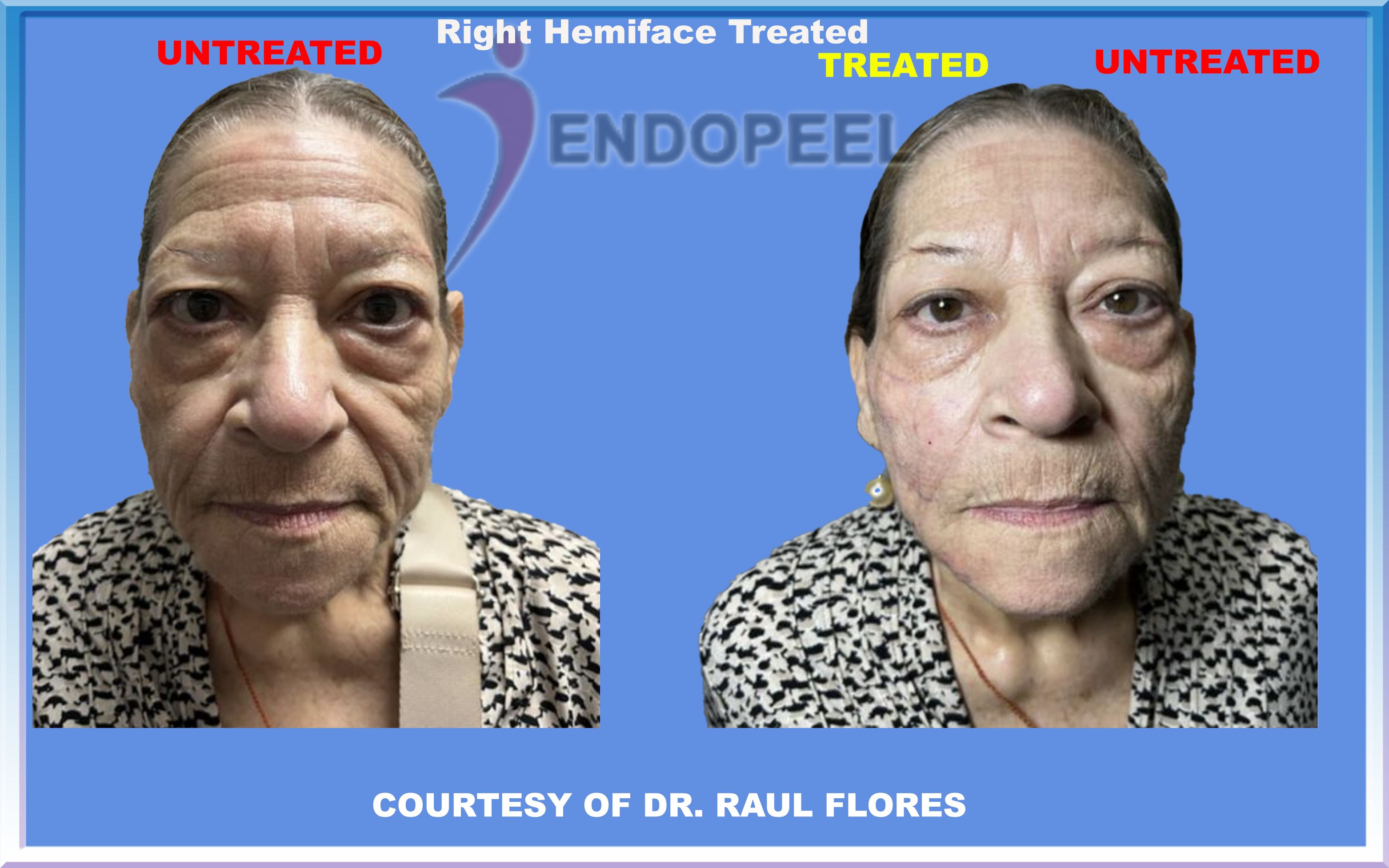 raul-flores-hemiface