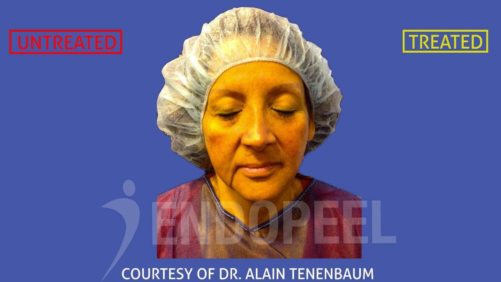 facecontour-Dr.Alain Tenenbaum